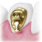 ortodonzia linguale -5